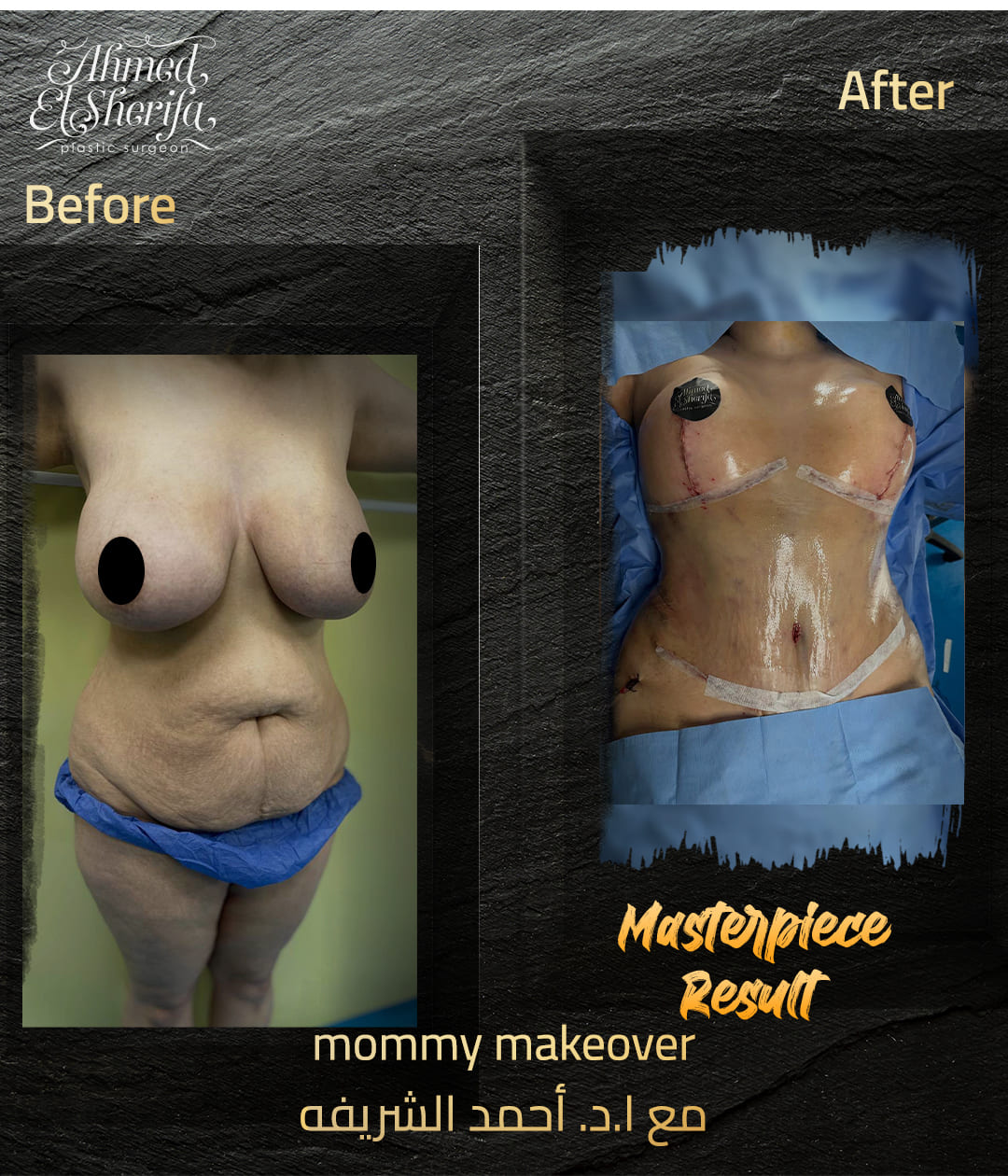 mommy makeover